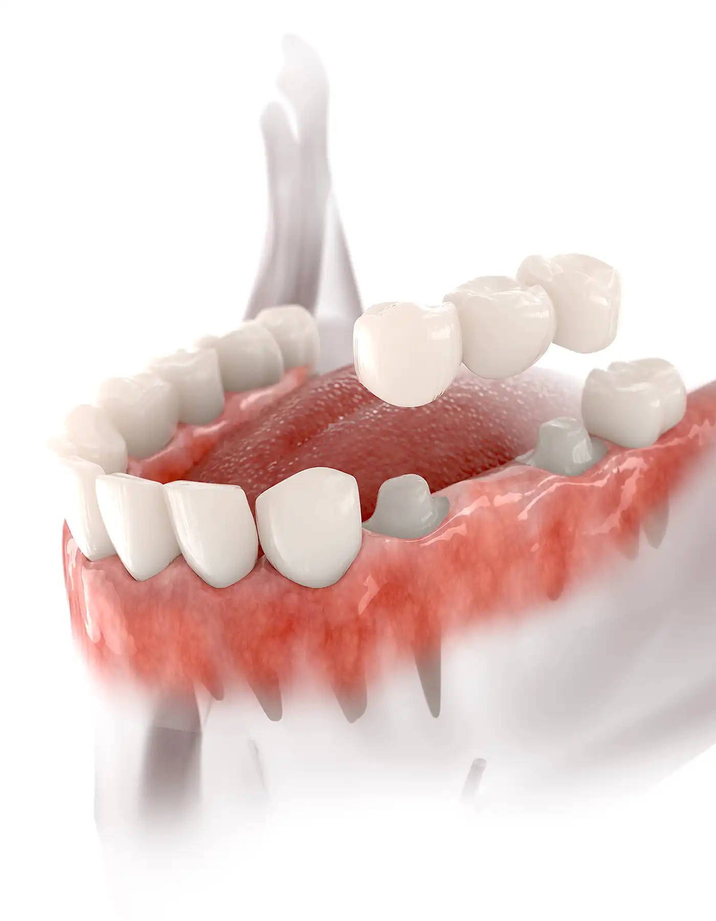 Dental Crowns & Bridges