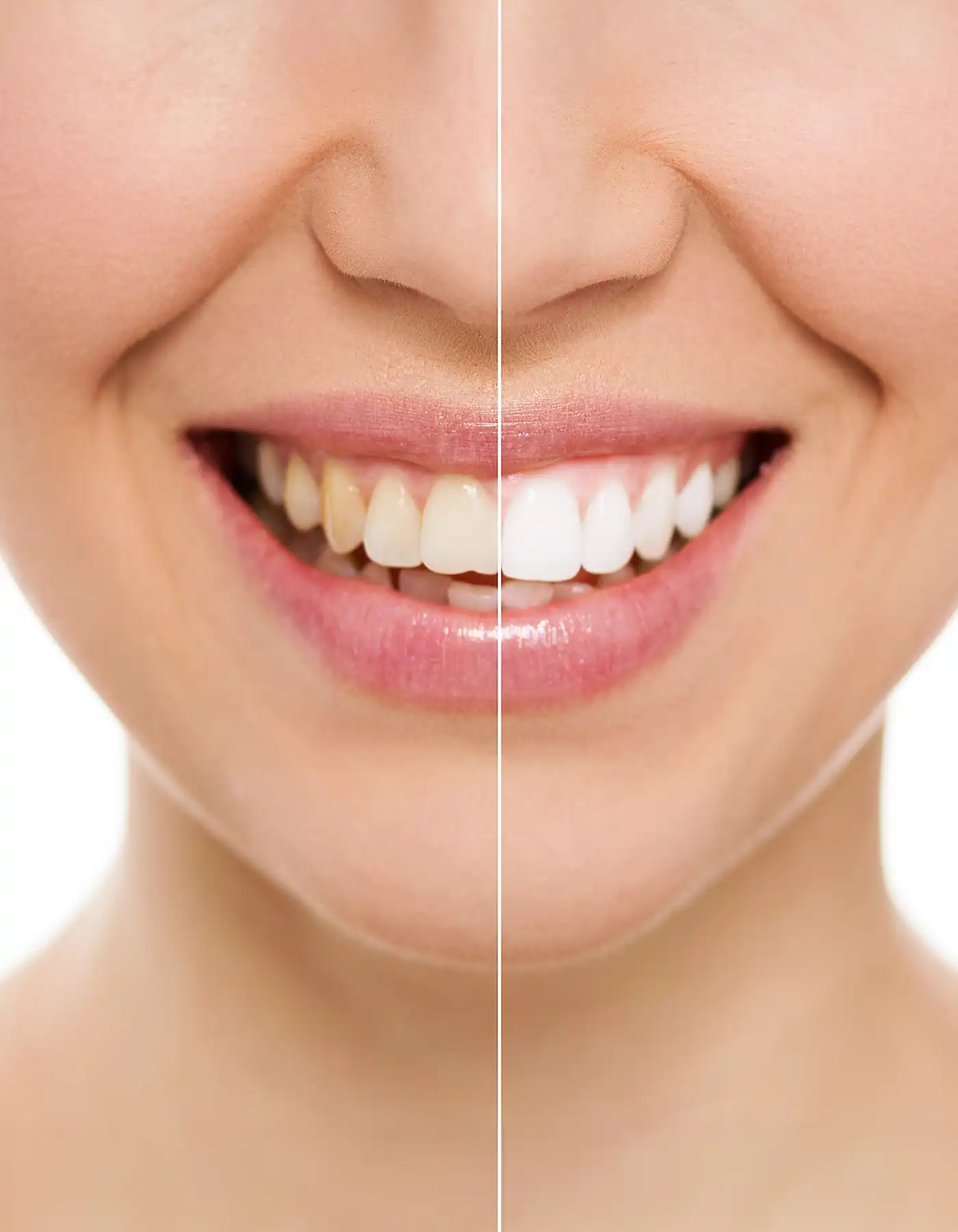 Teeth Whitening 